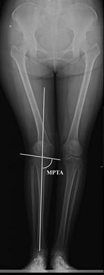 Correlation between tibial valgus deformity and aspect ratio of resected tibial surface in female Chinese patients undergoing total knee arthroplasty